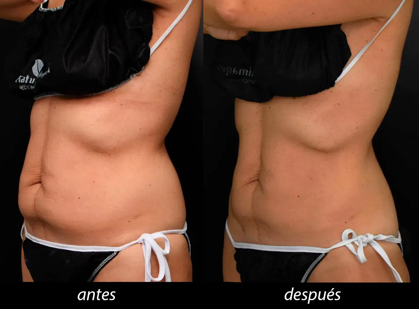 Antes-y-Despues-Tratamiento-con-Scizer (1)