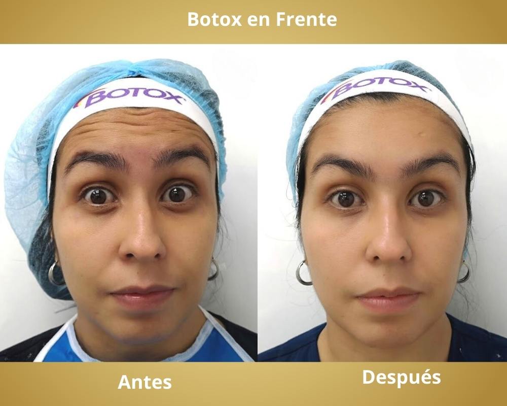 Botox en Frente Antes - Despues Bucaramanga