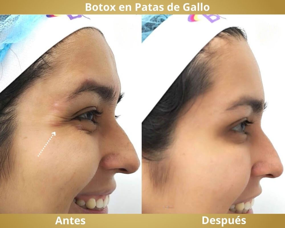 Botox Antes - Despues PAtas de Gallo Bucaramanga