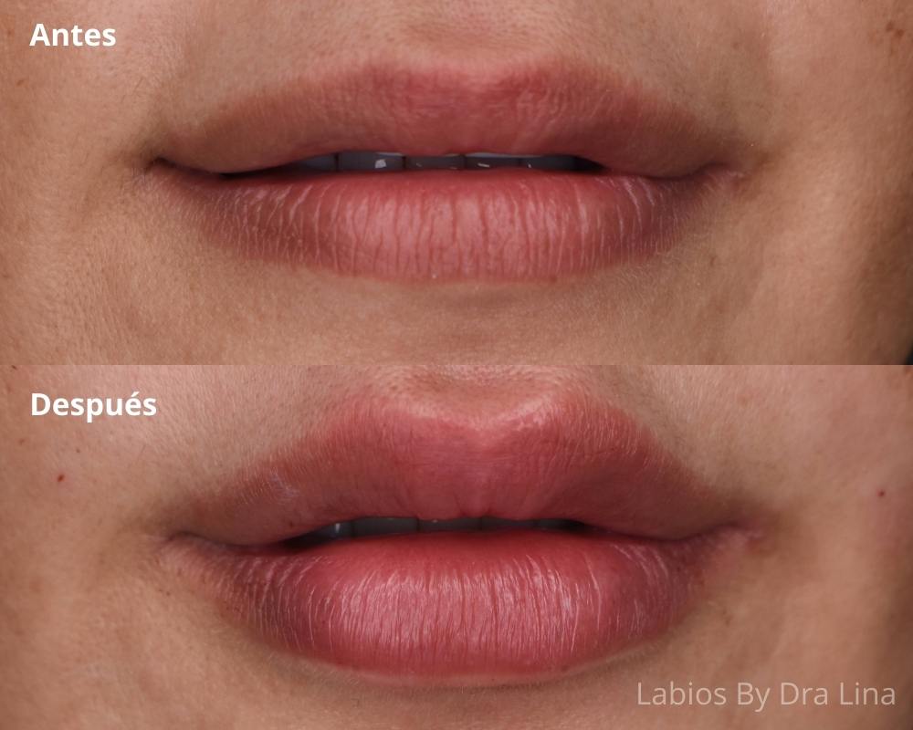 Antes y Después Diseño de Labios con Acido Hialuronico