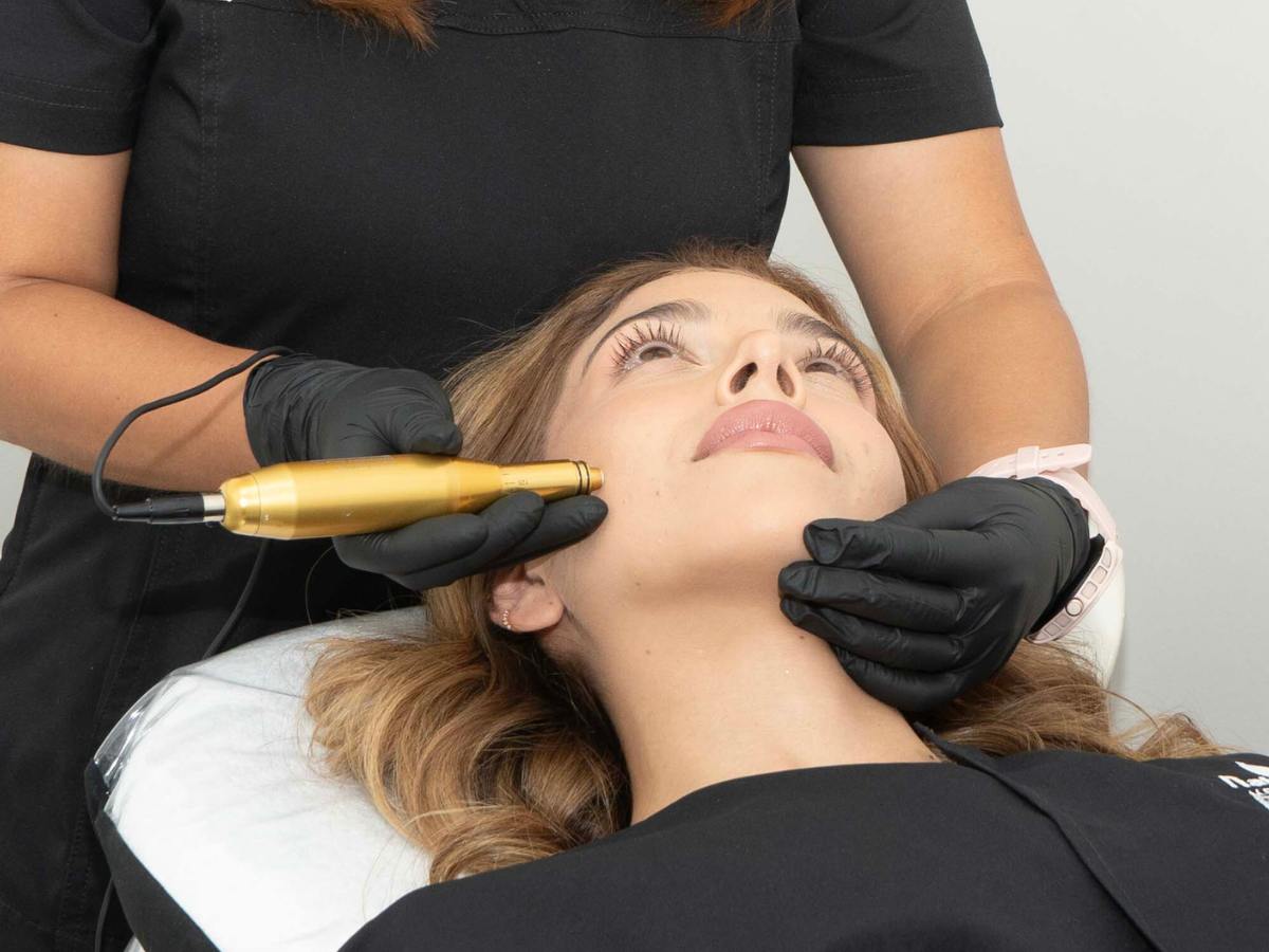 Nanopore - Microneedling en Bucaramanga