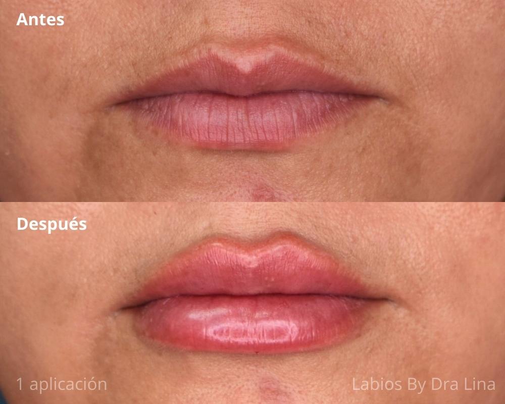 Relleno de Labios con Ácido Hialurónico